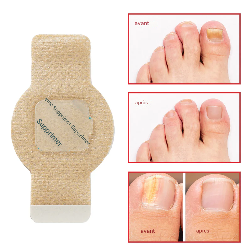 Pansements antifongiques pour ongles